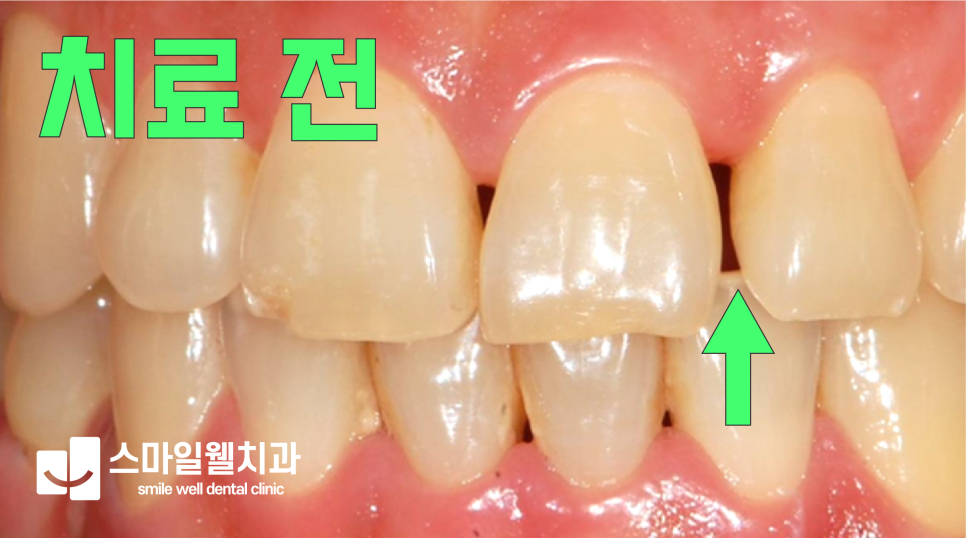 치아 사이에 공간이 벌어져 있는 치료 전 모습