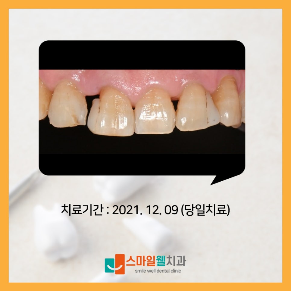 앞니 사이의 틈과 깨진 부위를 확인하는 진료 과정 사진