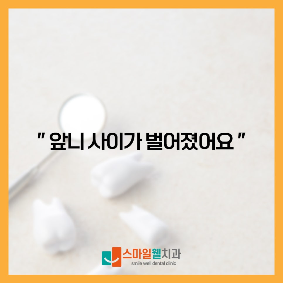 치아 사이가 벌어지거나 깨진 상태를 보여주는 치아 모델 사진