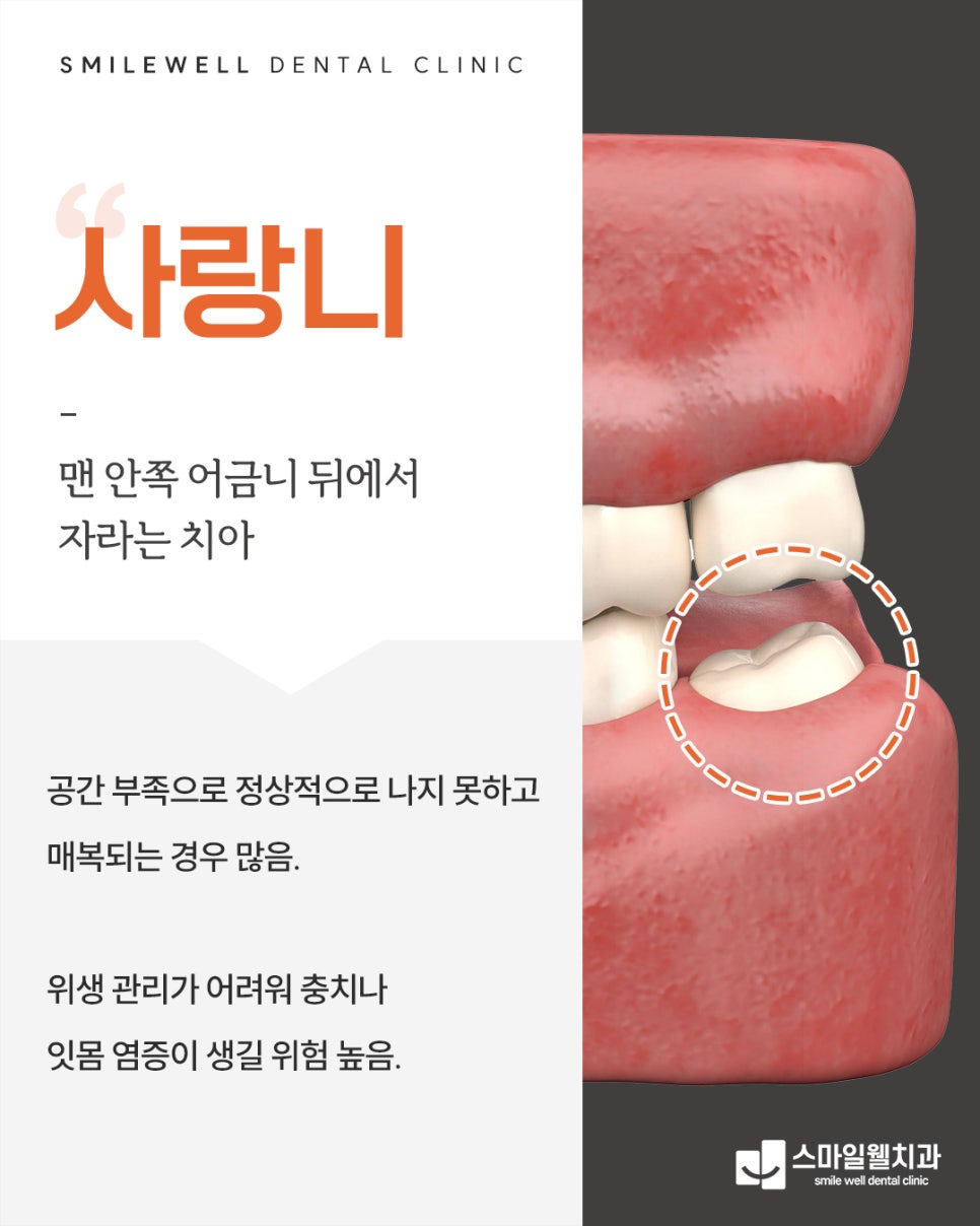 사랑니 발치, 꼭 해야 할까요? 주의사항과 판단 기준 정리