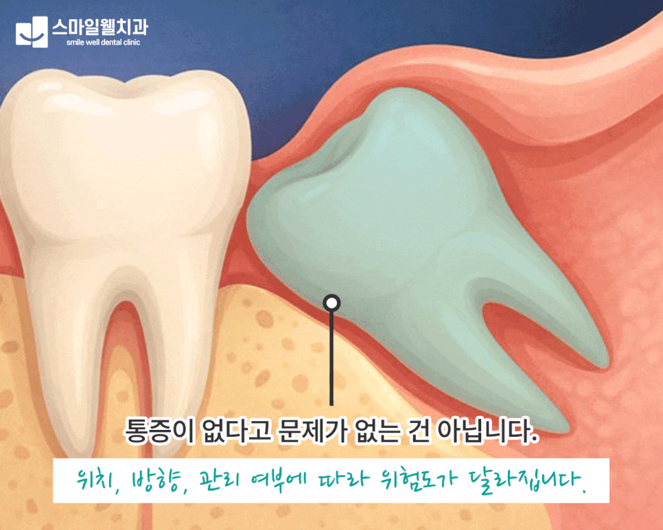 사랑니 발치, 안 아픈데 꼭 해야 하나요? [판단 기준 정리]