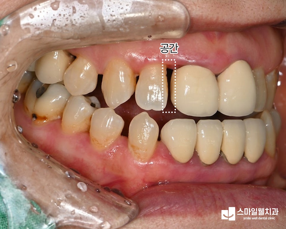 앞니 크라운, 잇몸 염증이 있다면? 치료 전 꼭 확인하세요