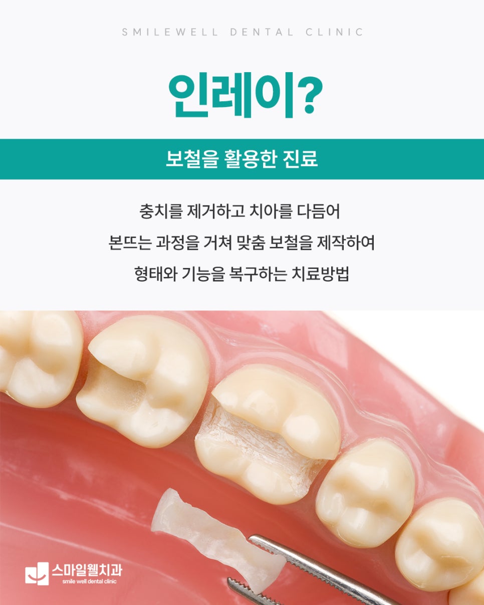 인레이 치료, 크라운 대신 선택하는 기준은? [종류·장점 정리]
