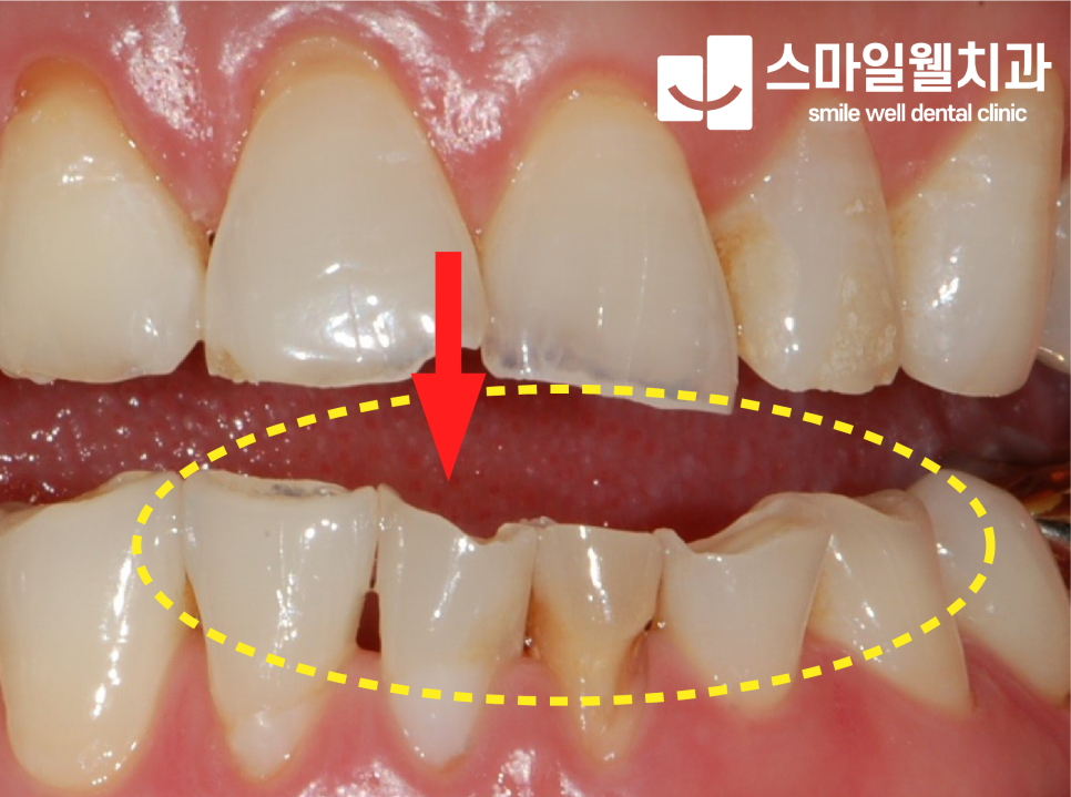 치아 파절, 그대로 두면 치아를 뽑아야 할까요? 원인과 대처법