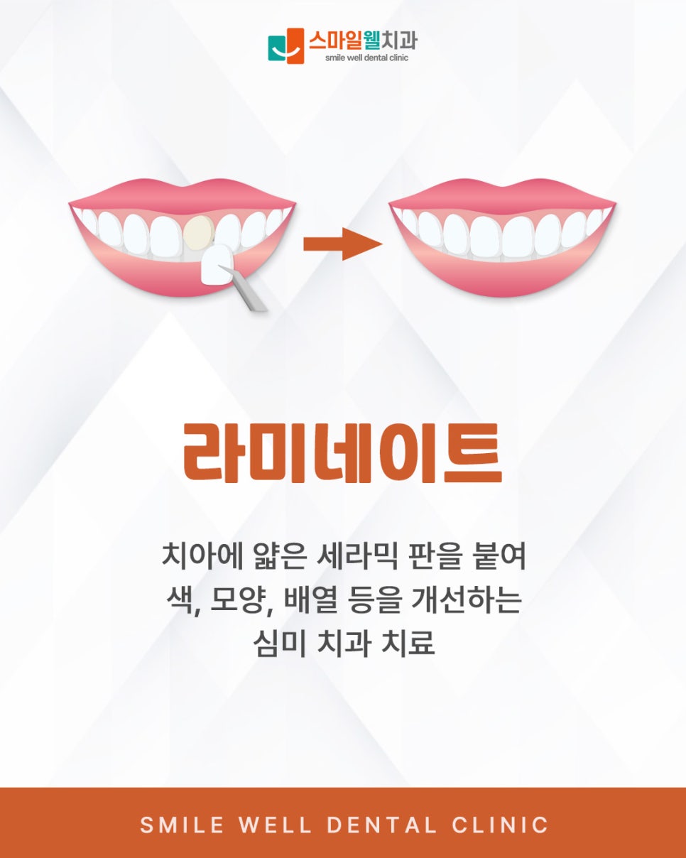라미네이트, 앞니 심미 치료 전 꼭 알아야 할 3가지