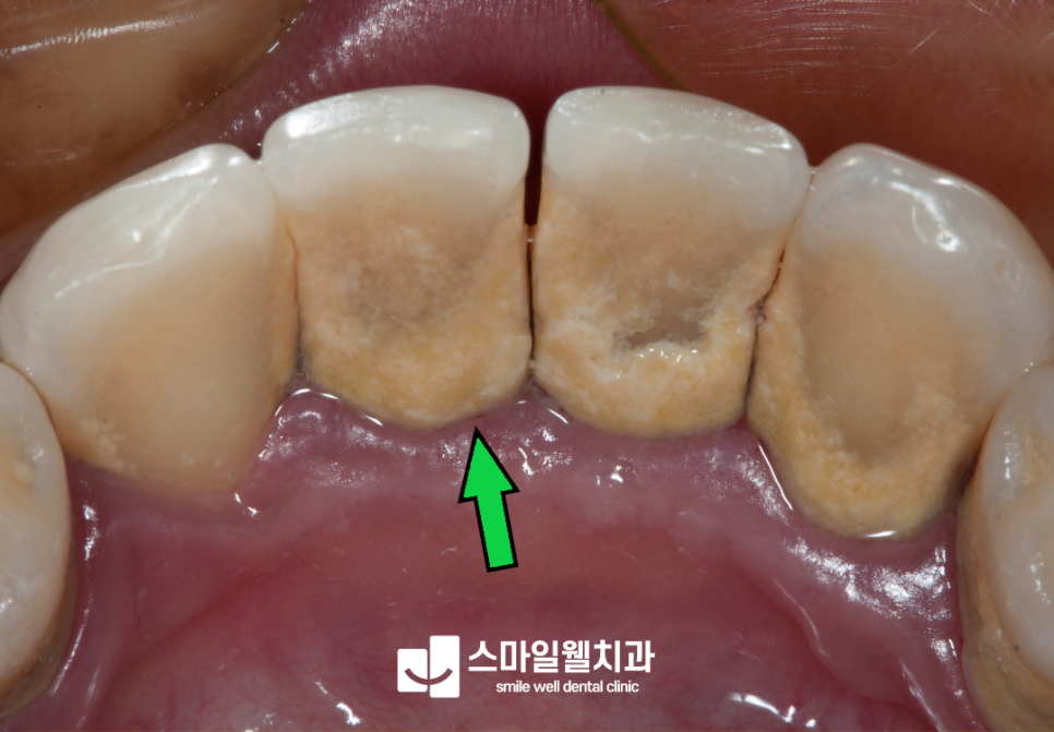 보험 스케일링 조건, 만 19세 이상이라면 1년 1회 혜택 확인하세요