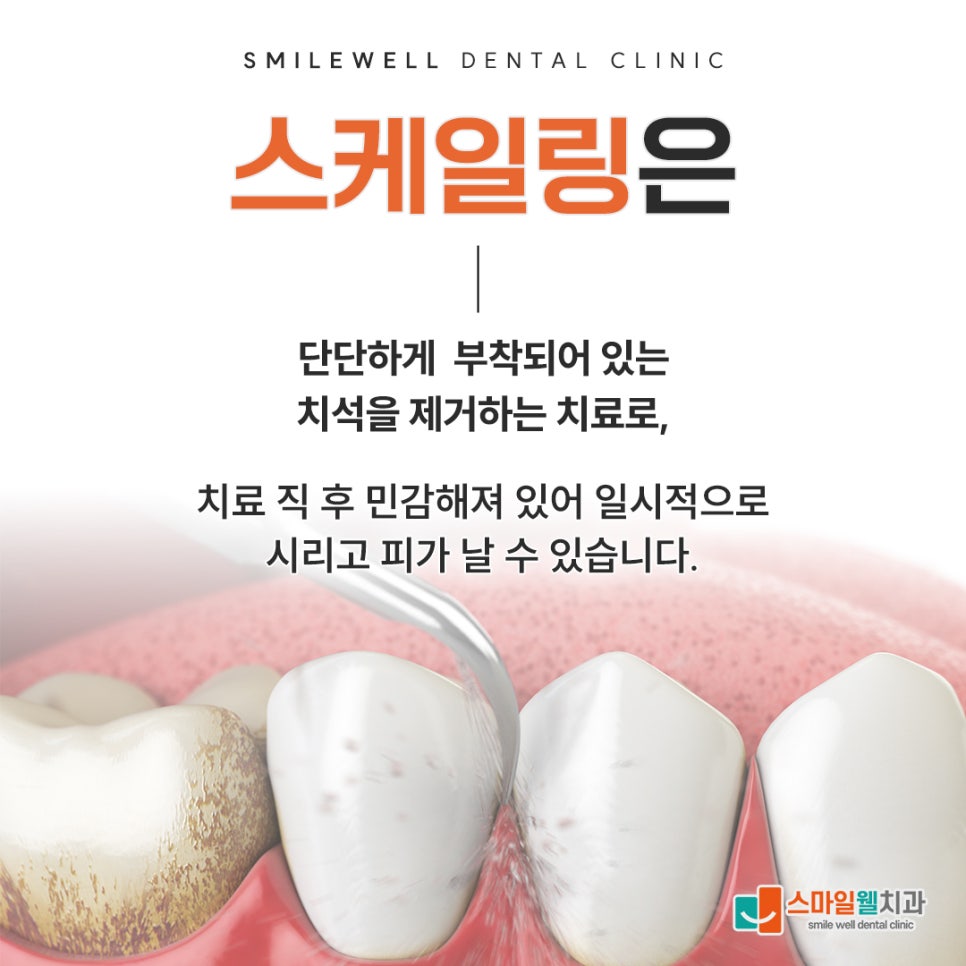 스케일링 후 주의사항, 식사와 시린 증상 관리법은?