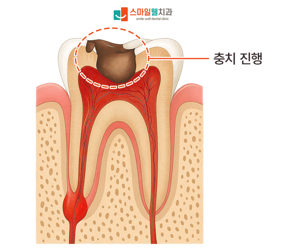 신경치료 과정, 보통 몇 번 방문하고 얼마나 걸릴까요?