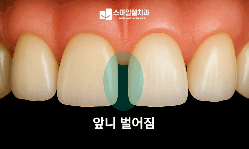 앞니 벌어짐 레진 치료, 하루 만에 가능할까요?