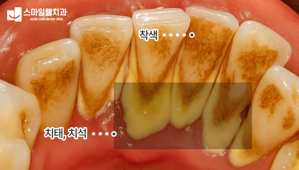 잇몸치료와 스케일링 차이점, 나에게 필요한 치료는?