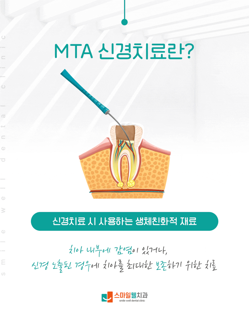 MTA 신경치료, 자연치아 살리는 데 효과적일까요?