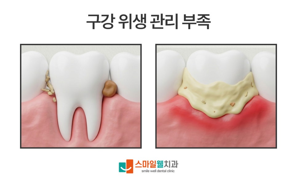 작은 충치 치료, 꼭 해야 할까요? 치과의사가 알려주는 단계별 기준