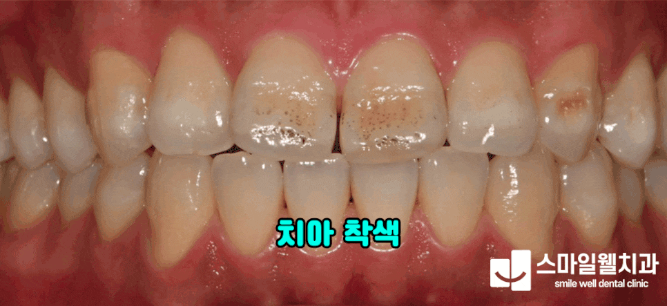 치아 변색, 원인 모를 착색 그대로 두면 안 되는 이유