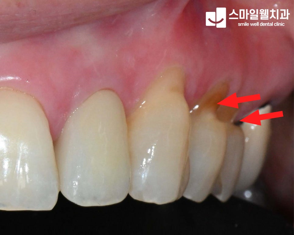 치경부 마모증, 치아 시림 원인과 치료 방법은?