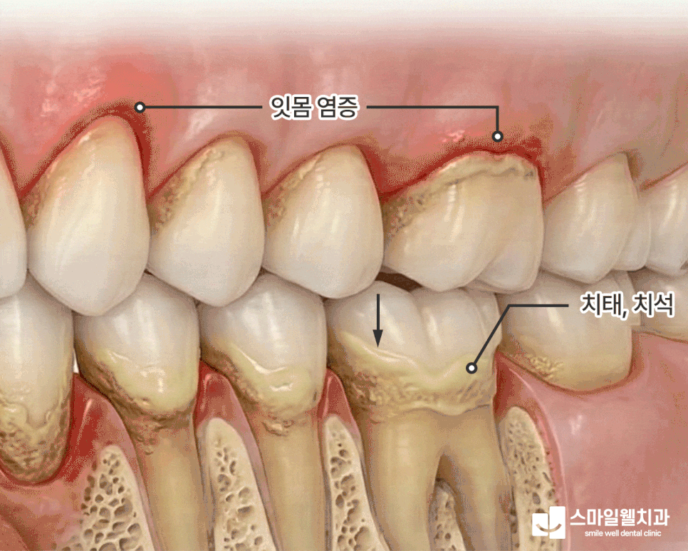 치주 질환 증상, 잇몸 피나고 붓는다면 꼭 확인하세요