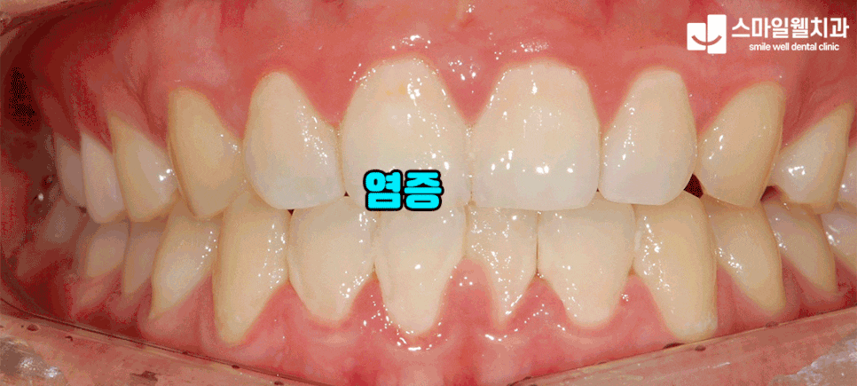 잇몸치료 주기, 상태별 권장 기간은? 치과의사가 정리해 드립니다