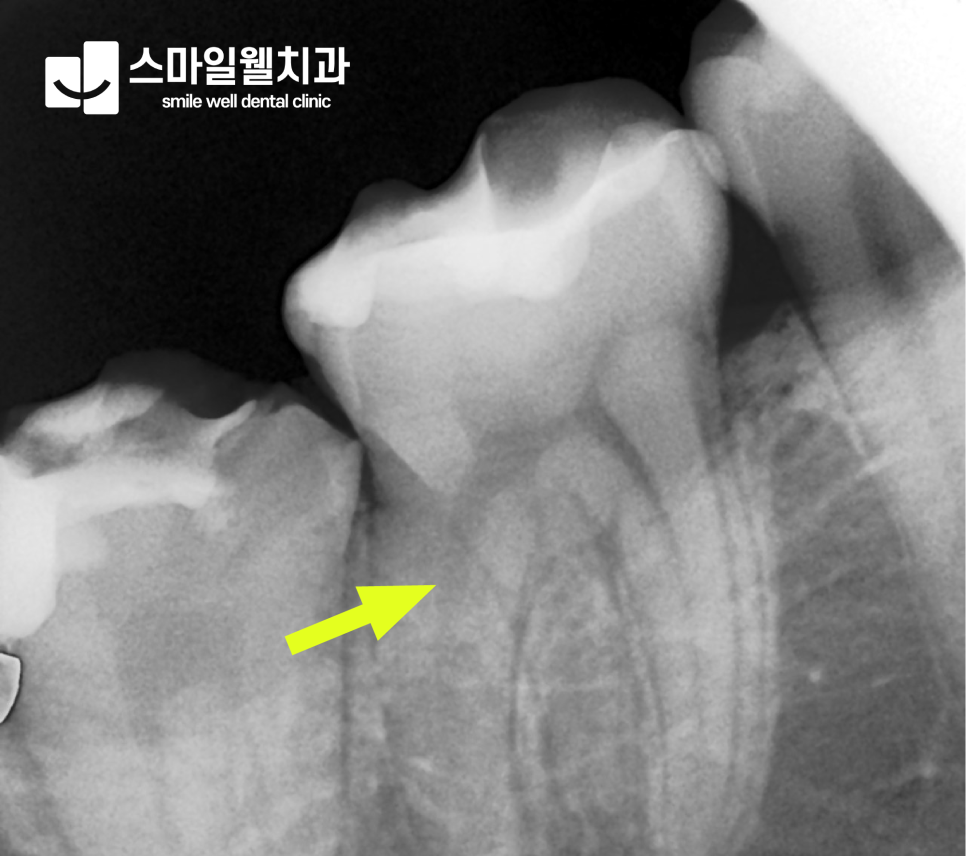 치아크랙 증상과 원인, 그대로 두면 안 되는 이유 3가지