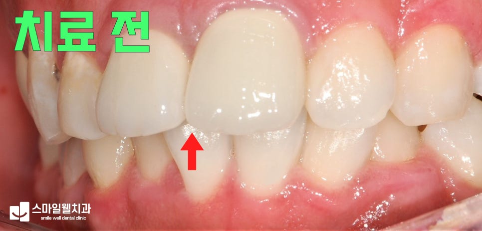 앞니 크라운, 지르코니아가 선호되는 3가지 이유는?