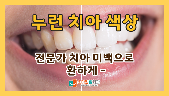 전문가 치아미백, 누런 치아를 밝게 만드는 방법은?