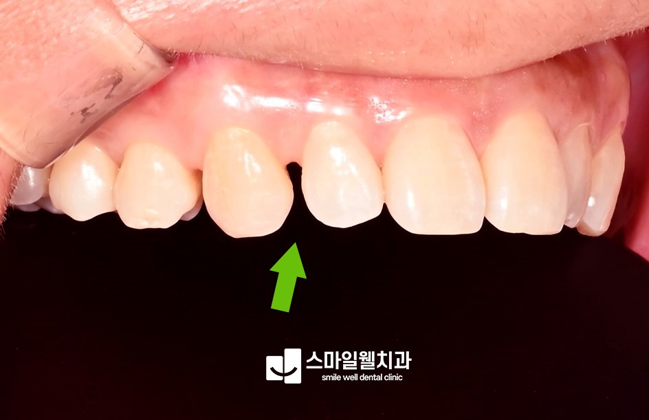 라미네이트, 치아 삭제가 걱정된다면? 무삭제 가능 여부 확인하기