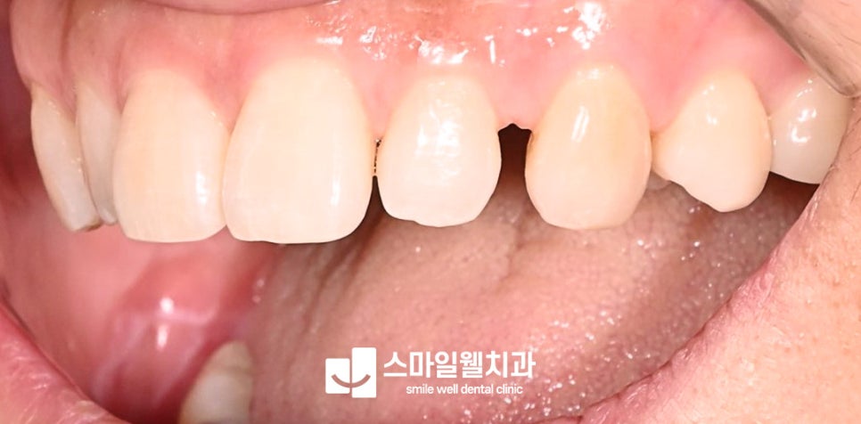 라미네이트, 치아 삭제가 걱정된다면? [무삭제·대상 정리]