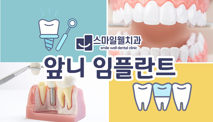 앞니 임플란트, 무절개 네비게이션으로 심미성까지 잡으려면?