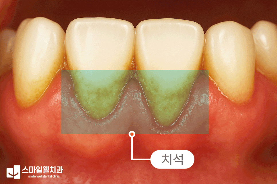 스케일링 통증과 시린 증상, 걱정된다면? [에어플로우 비교]