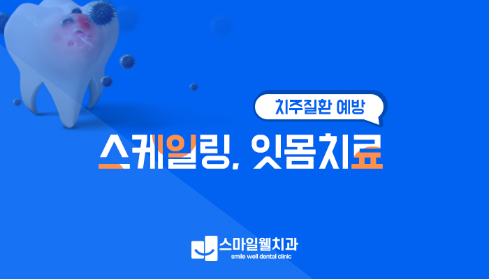 스케일링, 치주질환 예방을 위해 꼭 해야 할까요?