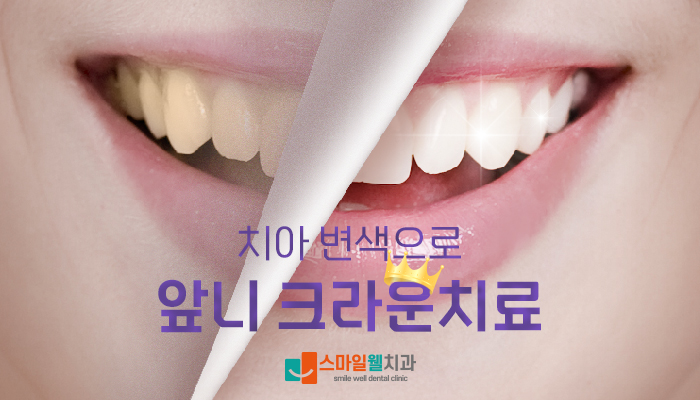 신경치료 후 치아 변색, 왜 생기며 어떻게 해결하나요?