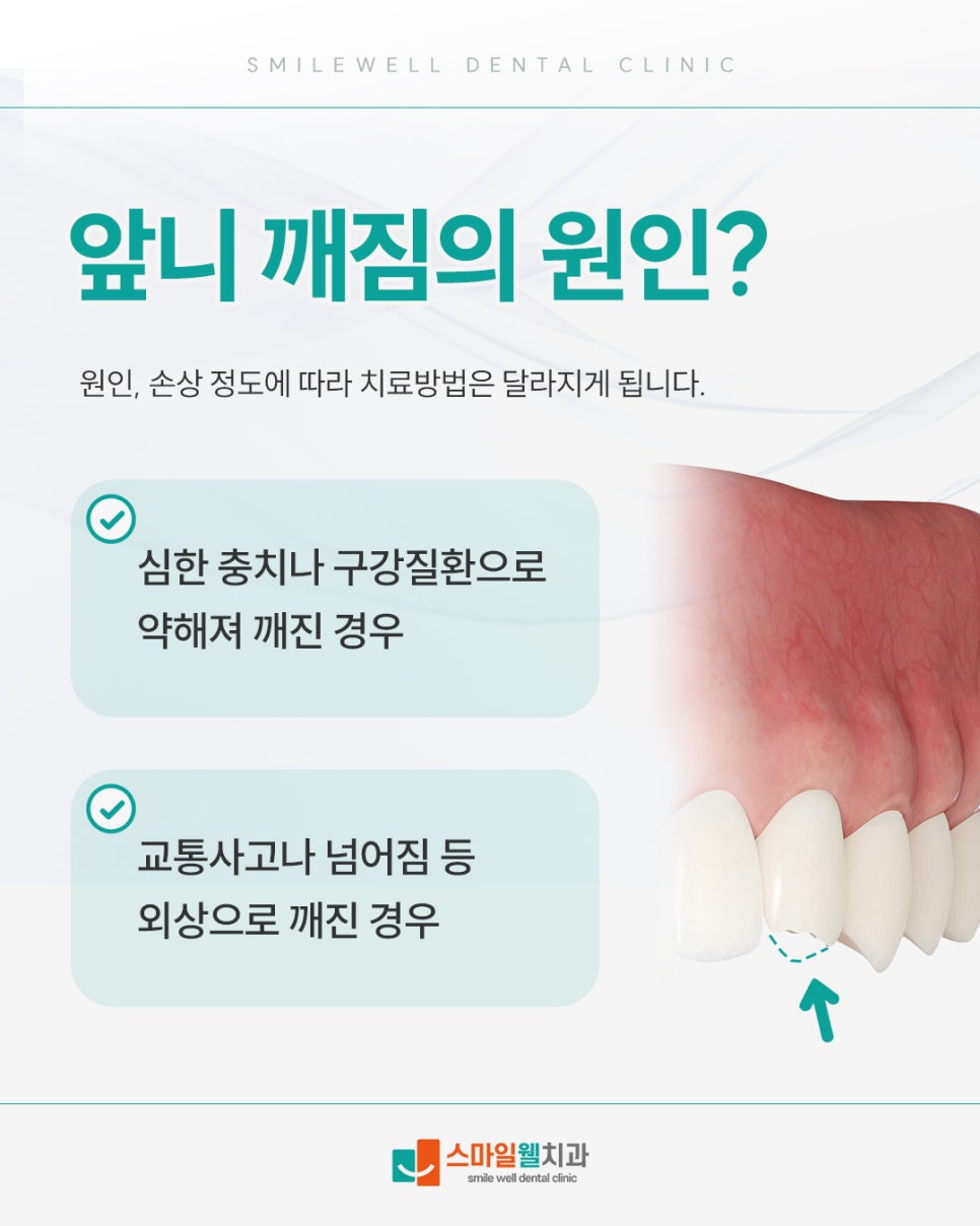앞니 깨짐, 단계별 치료방법은 무엇인가요? [원인·방법 정리]