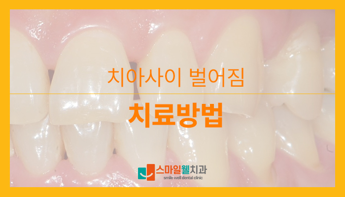 앞니 벌어짐, 레진으로 당일 해결 가능할까요?