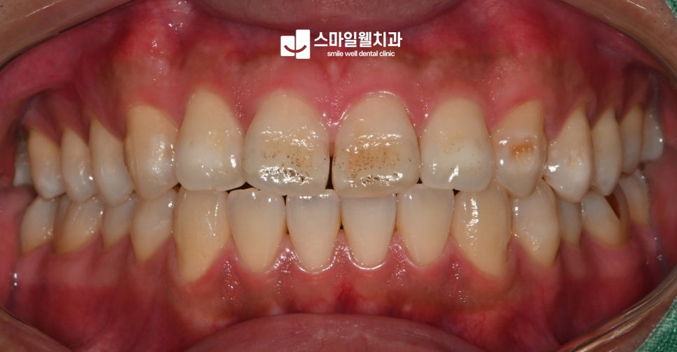 앞니 착색과 벌어짐, 심미적인 개선 방법은?