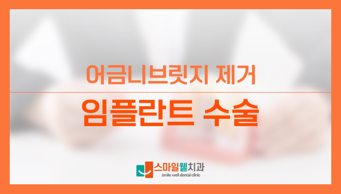 어금니 임플란트와 브릿지, 나에게 맞는 선택은? [차이점 비교]