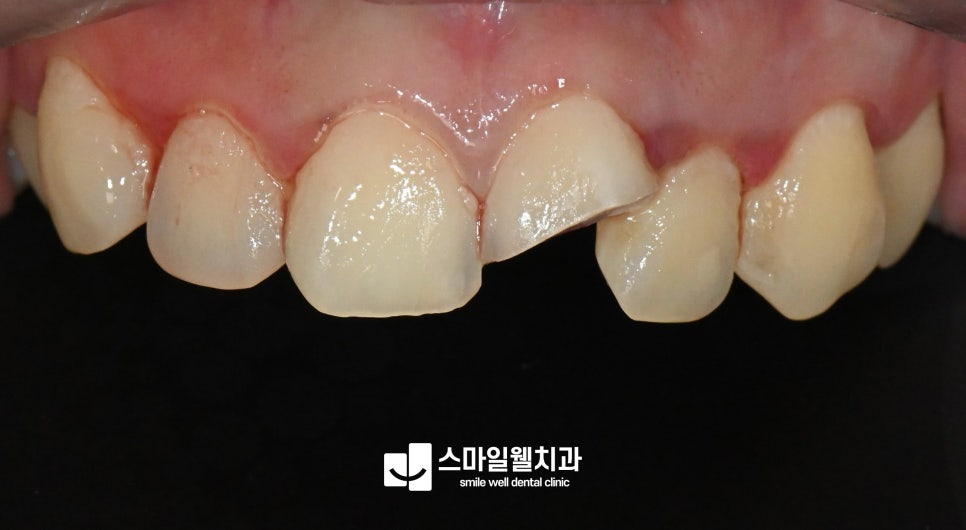 치아 파절, 깨진 정도에 따른 치료 방법은? [대처법 정리]