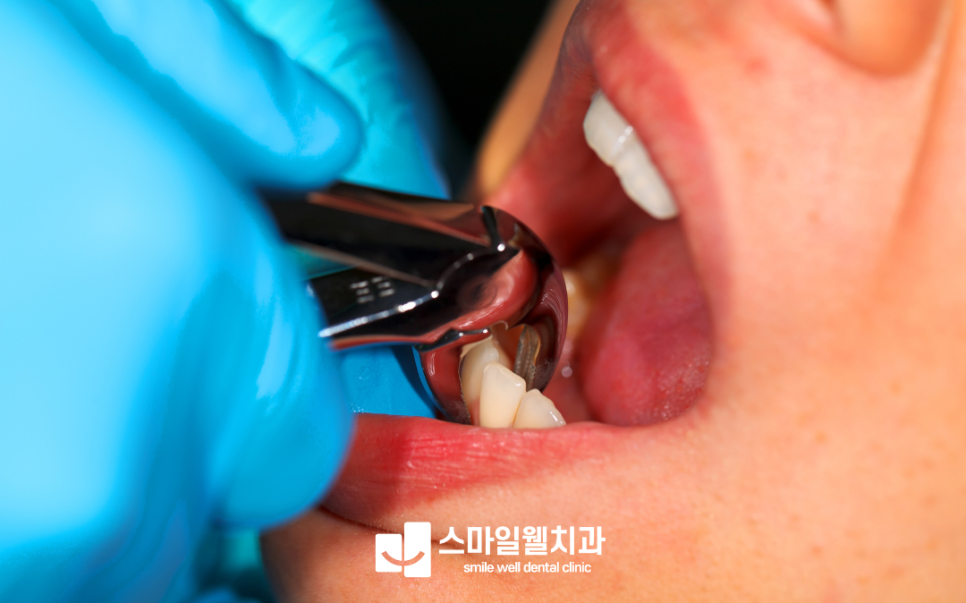 유치 발치 시기, 언제 뽑는 게 좋을까요? 치과의사가 알려주는 주의사항