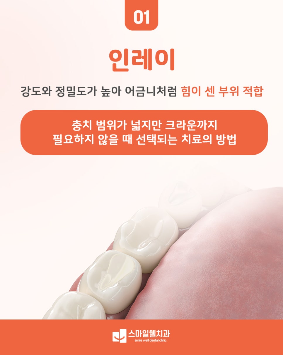 인레이 치료, 크라운 대신 선택하는 기준은? [종류·과정 정리]