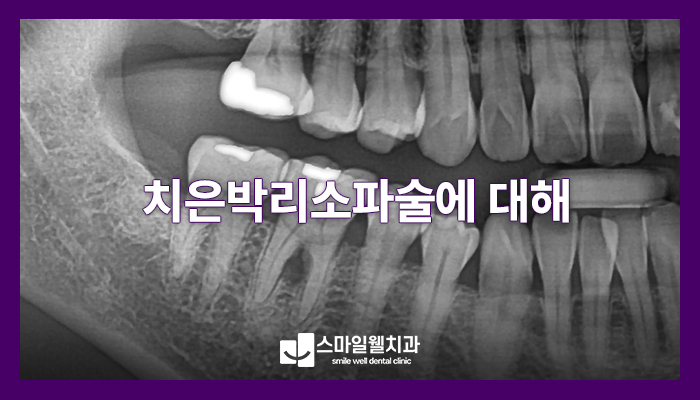 치은박리소파술, 잇몸 염증 심할 때 꼭 해야 하나요?