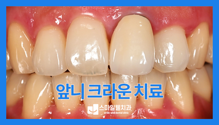 잇몸변색 원인과 앞니 크라운 교체, 어떻게 진행되나요?