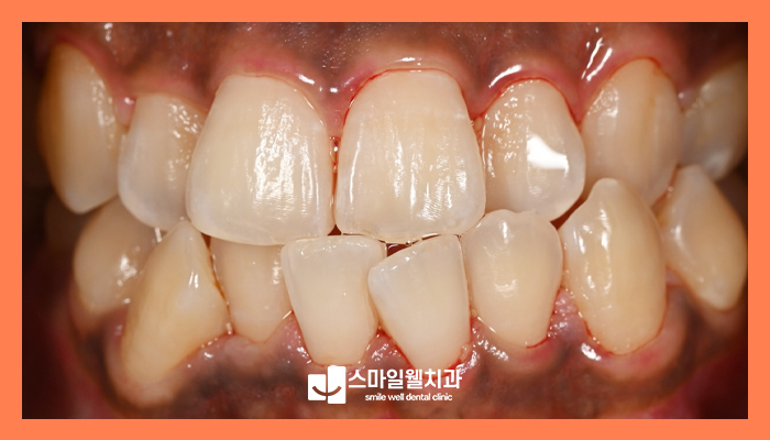 잇몸미백, 검게 변한 잇몸 색상 회복할 수 있을까요?