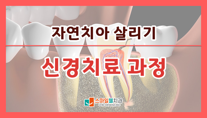 신경치료 과정, 자연치아 살리는 방법은 무엇인가요?