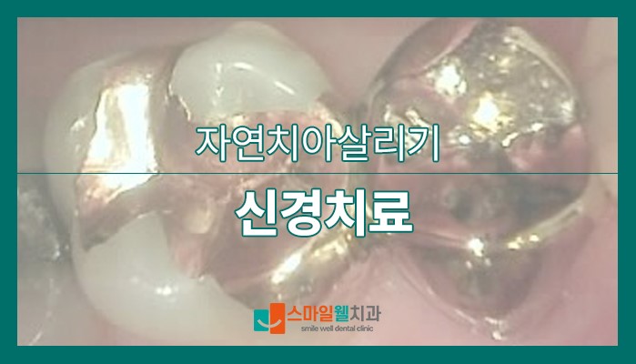신경치료, 자연치아 살리는 방법일까요? [과정·주의사항]