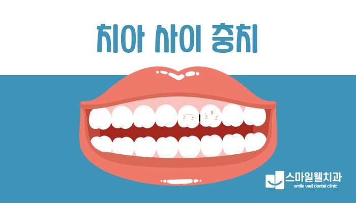 치아 사이 충치, 레진으로 당일 치료 가능한가요?