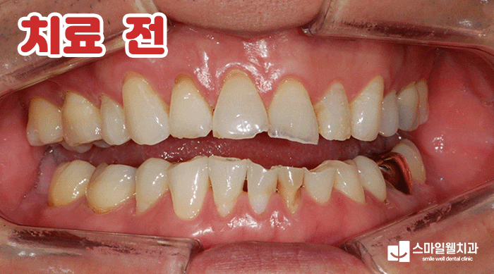 치아 마모 깨짐, 그대로 두면 안 되는 이유와 치료 방법은?