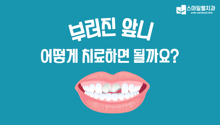 치아 부러졌을 때 대처법, 자연치아 살리는 응급처치 3가지