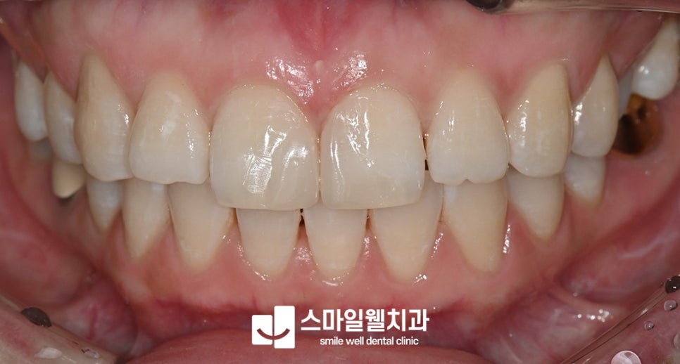 앞니 치아 사이 벌어짐, 레진으로 하루 만에 해결할 수 있을까?