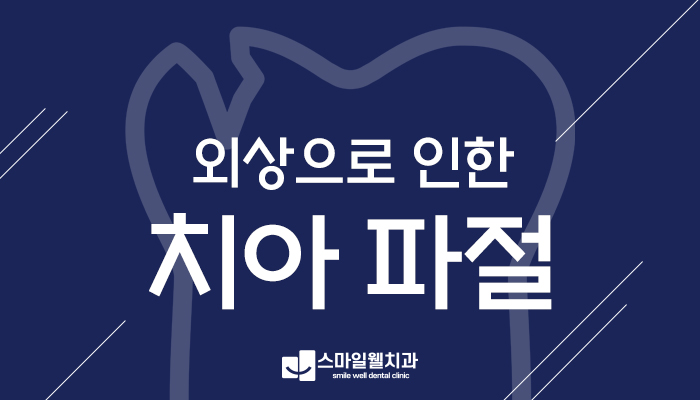 치아파절 치료방법, 깨진 범위에 따라 어떻게 달라질까요?
