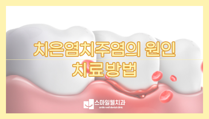 치은염 치주염 차이, 잇몸 붓고 피난다면 확인하세요