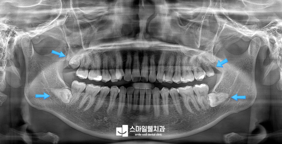 치아 크랙 통증, 씹을 때 시큰거린다면? 원인과 단계별 치료법