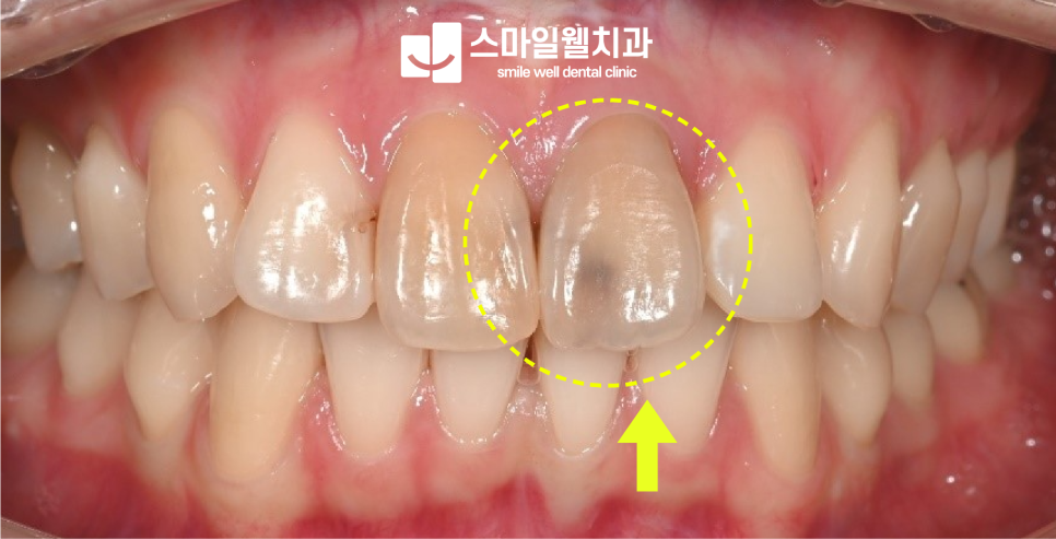 치아 변색, 검게 변한 앞니 해결 방법은? [실활치 미백 정리]