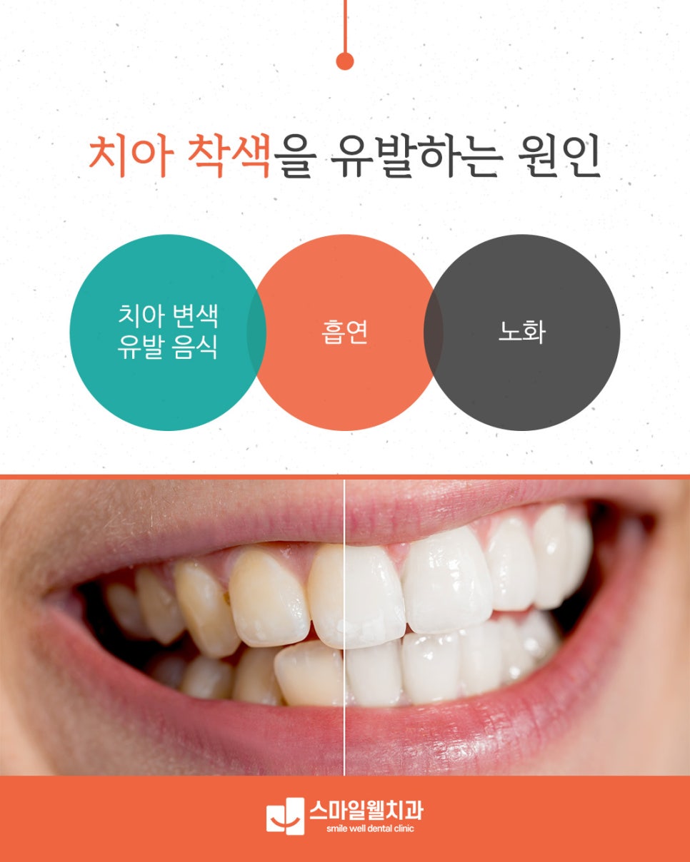 치아 착색 원인과 해결 방법, 밝은 미소를 위한 관리법은?